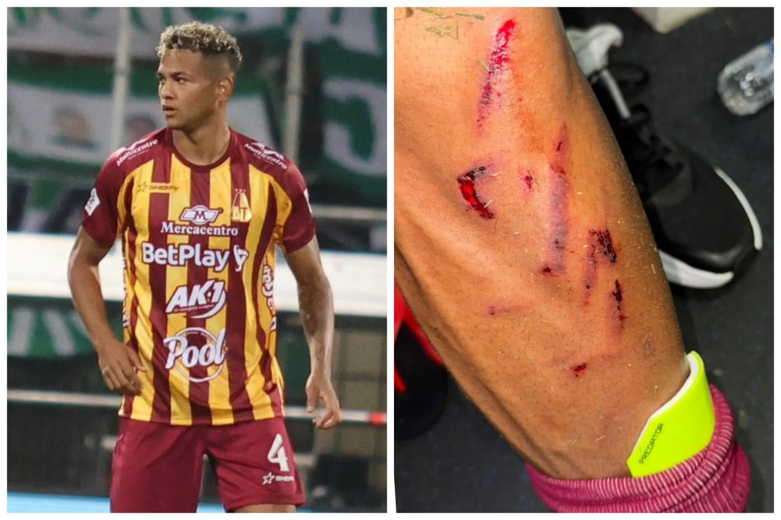 César Haydar y la violenta herida que sufrió en la victoria del DEPORTES TOLIMA ante Atlético Nacional: acción causó 'pataleo' verdolaga en redes